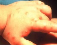 Pustules and blisters on hand