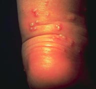 Pustules and blisters on ankle